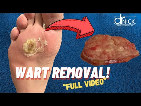 SURGERY TO REMOVE LARGE PLANTAR WART| Dr. Nick Campitelli | Akron Podiatrist