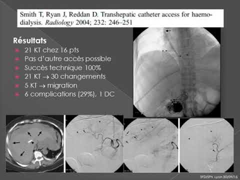 Vidéo: Impacts Potentiels D'un Nouveau Flux De Travail Extracorporel-RCR Intégré Utilisant Une Radiologie Interventionnelle Et Un Système De Tomodensitométrie Corps Entier Immédiat A