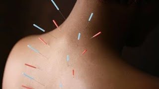 علاج الام الرقبه والكتف بالابر الصينيه  balance method acupuncture for neck pain