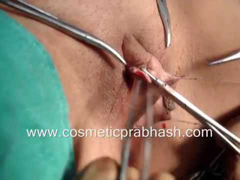 Unhooding clitoris bangkok Tube8 anal deepthroat