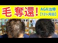 【AGA治療・薄毛治療体験レポート12ヶ月目】薄毛に悩む30代40代男性向け『1年間の総集編』