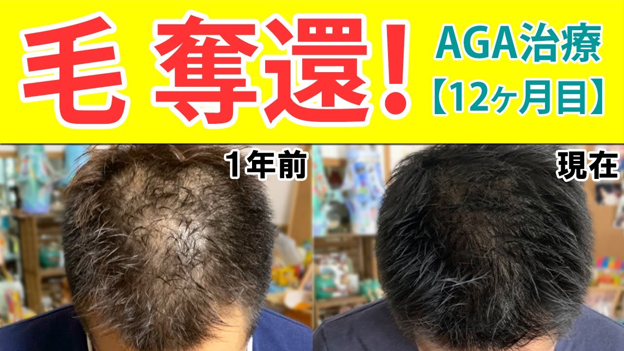 【AGA治療・薄毛治療体験レポート12ヶ月目】薄毛に悩む30代40代男性向け『1年間の総集編』