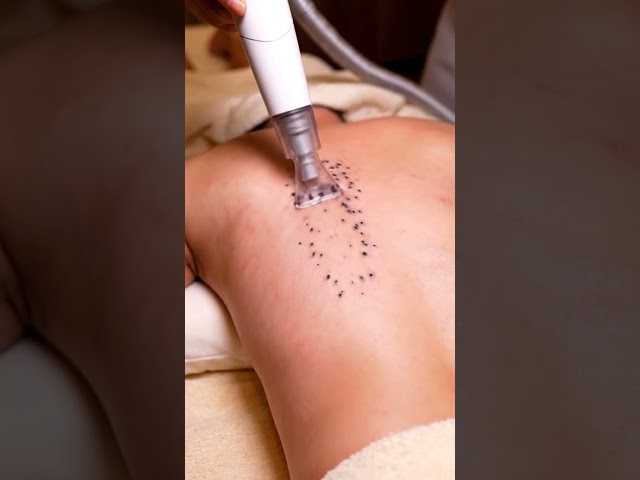 Deep Pore Cleaning Transformation ✨