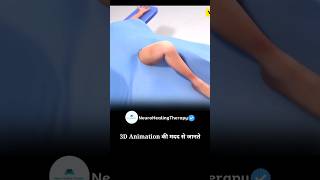 Knee Joint Surgery #viral
