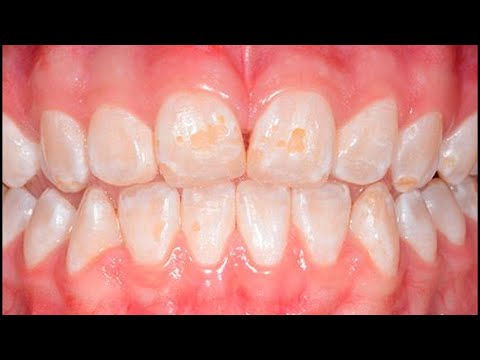 Video: 3 formas de tratar el esmalte de dientes débiles