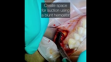 Going after a Tooth Root in the Maxillary Sinus with a Caldwell-Luc Approach