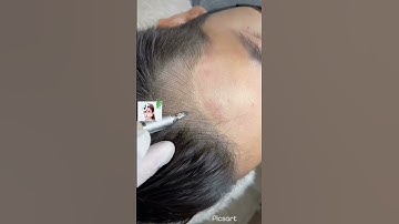 8 giây thay đổi mái tóc ( đầu hói - tóc rụng ). Người thật - việc thật - sự thật - đẹp thật