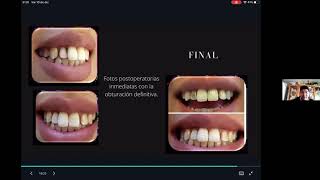 Blanqueamiento Dental Interno