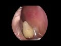 Tooth Growing Inside Nose Causes Nasal Congestion?