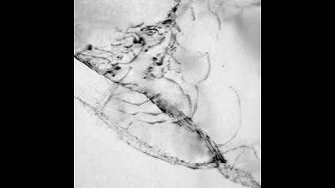 Dancing dislocation!