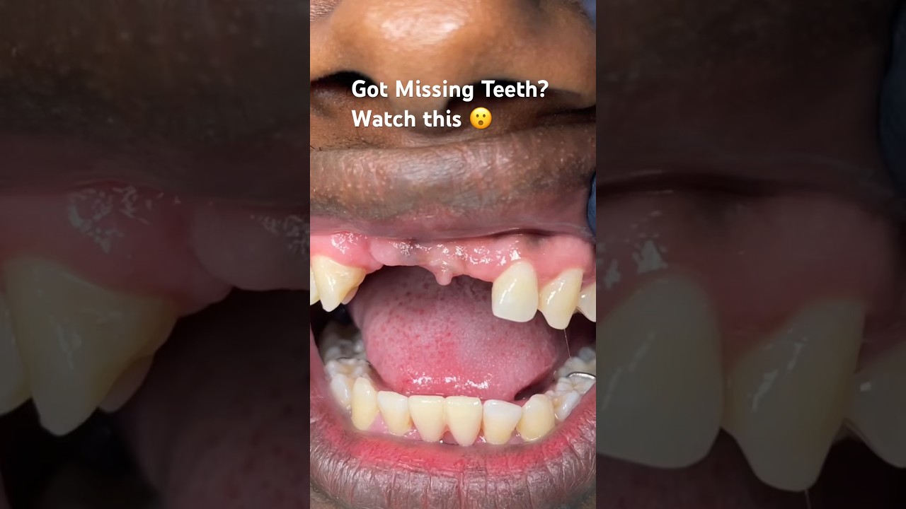 Got Missing Teeth ? Can't afford Implants? Hate your partial ? Watch this 😮