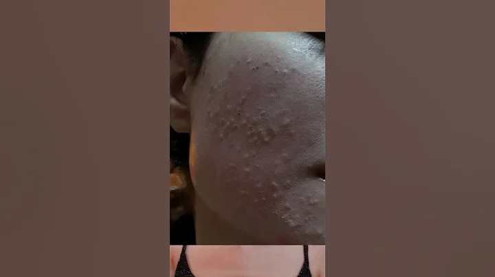 Comedonal acne treatment with pharmacy gel Adorg B💮 before and after #skincare #viral #shorts