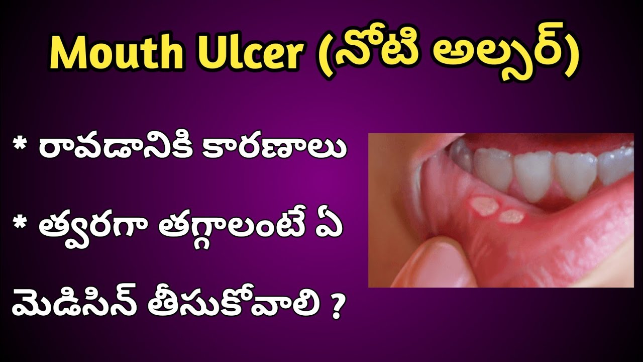 Mouth Ulcers Reasons and Treatment in Telugu