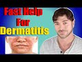 Fast Help For Seborrheic Dermatitis | Face and Scalp | Chris Gibson