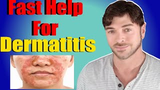 Fast Help For Seborrheic Dermatitis | Face and Scalp | Chris Gibson