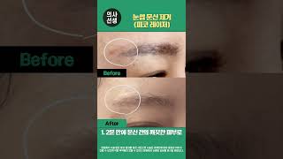 연신내피부과 ✌눈썹 문신 제거(피코 레이저) 전/후
