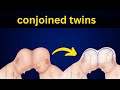 Conjoined twins conjoined twins types  demystifying science