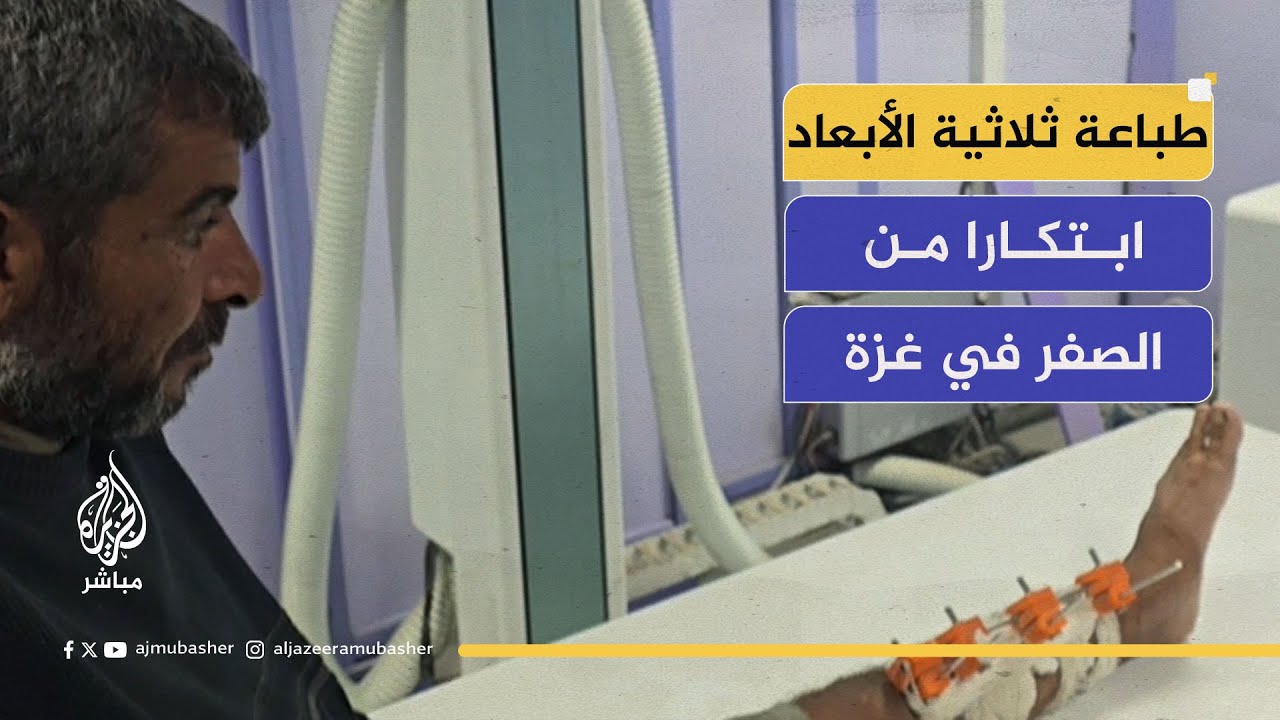 صناعة مثبت خارجي محلي لإنقاذ المصابين وسط نقص الأدوات الجراحية.