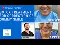 #gummysmilecorrection#drvarunnambiar Botox Treatment For Correction Of Gummy Smile |Dr.Varun Nambiar