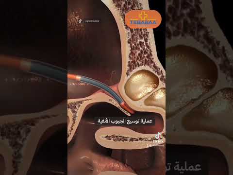 إجراء جراحي يعمل على توسيع الجيوب الأنفية بواسطة البالون يتم إدخاله عبر الأنف لاستعادة وظيفةالجيوب