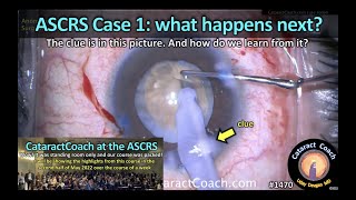 CataractCoach 1470: ASCRS case 1: what happens next?