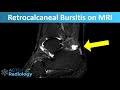 How to differentiate between Retrocalcaneal Bursitis and normal on ankle MRI