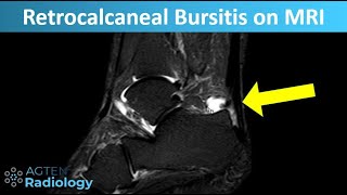 How to differentiate between Retrocalcaneal Bursitis and normal on ankle MRI