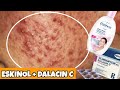 Cheap Acne Solution Eskinol And Dalacin C WOW EFFECTIVE Cheap Acne Solution Eskinol And Dalacin C WOW EFFECTIVE