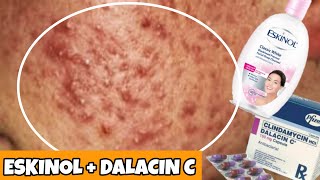 Cheap Acne Solution: Eskinol and Dalacin C | WOW!! EFFECTIVE??