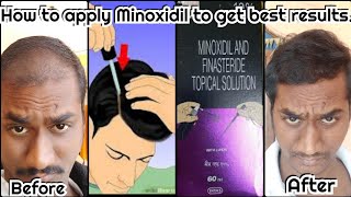 How to use Minoxidil to get maximum result. Minoxidil for hair re growth. #morrf #hair4u