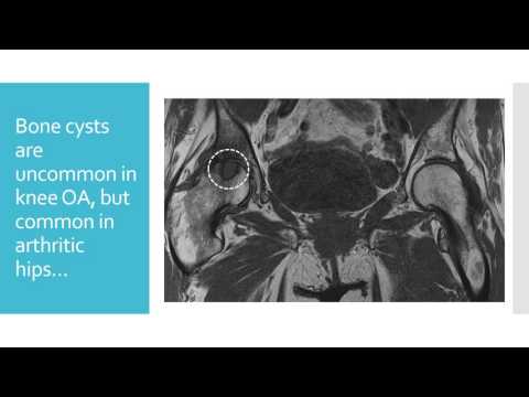 Hip Arthritis Getting Worse?