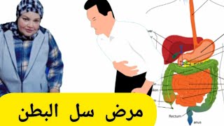 مرض سل البطن  ليه دلوقتي بنتكلم عن مرض درن البطن والجهاز الهضمي @dr.omhashem