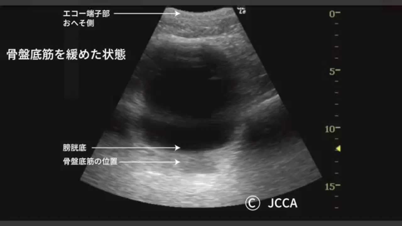 骨盤 頭 はまる エコー