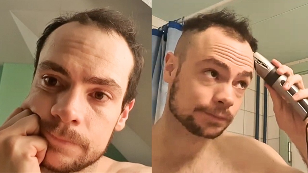 ЛЫСЕНИЕ — «Я боюсь быть непривлекательным»