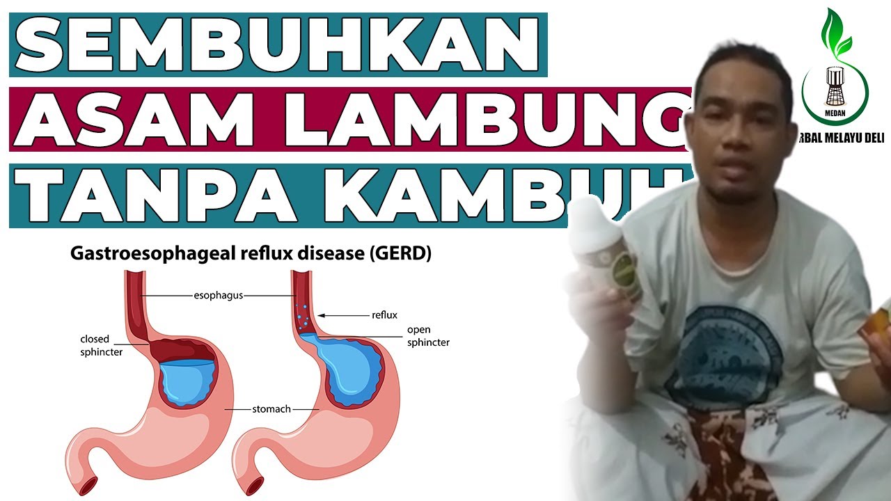 Cara Mengobati Asam Lambung
