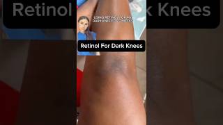 Dark Knees Vanish With This Retinol Secret