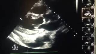 Left Pleural Effusion Seen on Transthoracic Echo.