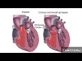 Стеноз легочной артерии. Как лечить стеноз легочной артерии.