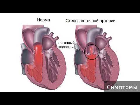 Стеноз легочной артерии. Как лечить стеноз легочной артерии.