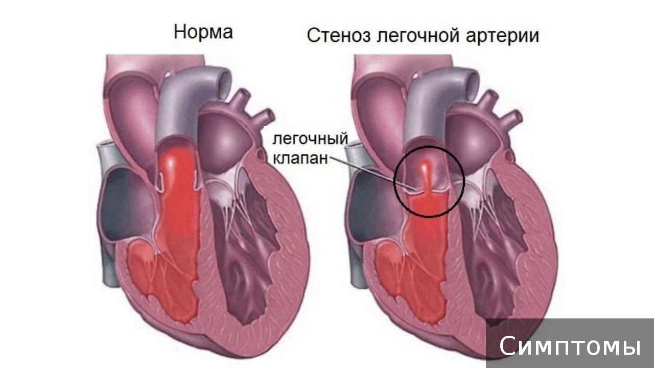 Реферат: Недостаточность клапанов и сужение отверстия легочной артерии