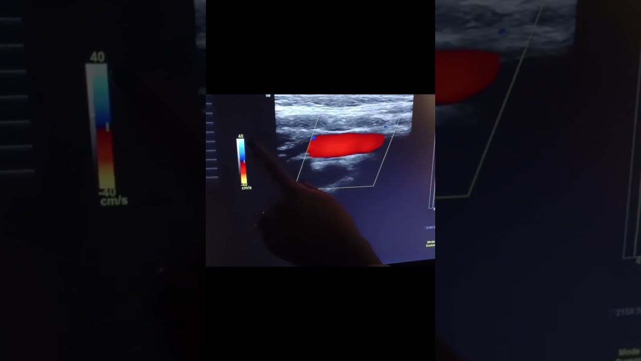 Optimizing Doppler Settings When Imaging