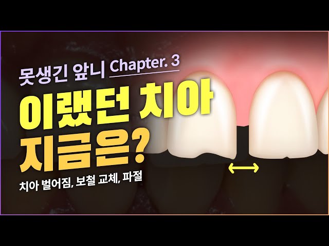 [3탄] 벌어진 앞니 이렇게 해보세요❗ (feat.보철교체, 파절)
