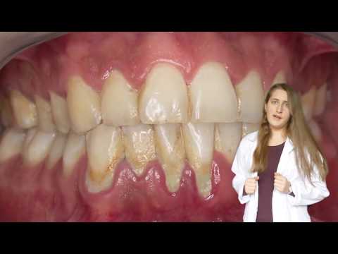 Video: Ochorenie ďasien - Rozdiel Medzi Gingivitídou A Parodontitídou, Periodontálnym Ochorením, Periodontitídou