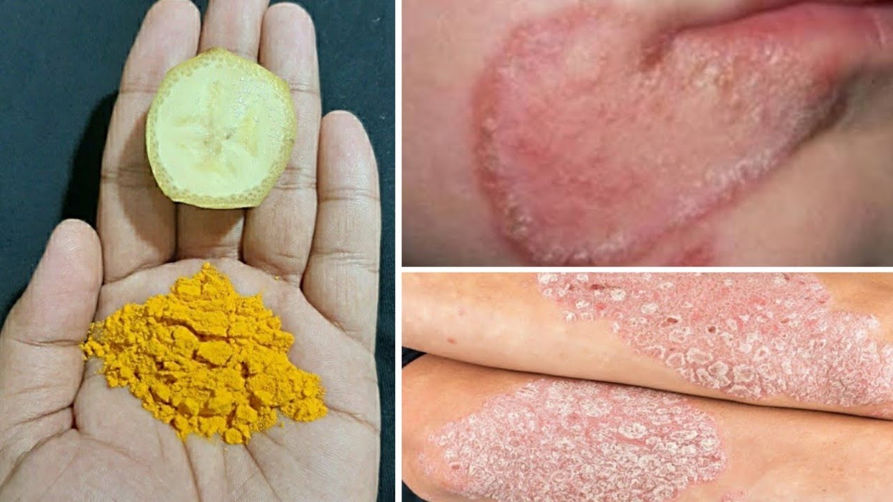 दाद खाज खुजली कि 2 दिन में छुट्टी कर देगा fungal infection treatment