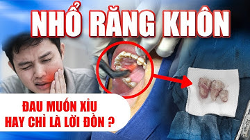 Nhổ Răng Khôn Bằng Piezotome - Đau Muốn Xỉu Hay Chỉ Là Lời Đồn | Nam Bùi Vinalign