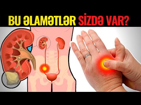 Böyrəkdə Problem Varsa - Bu 10 Əlamət Olur