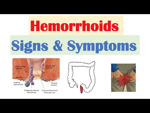 Hemorrhoids Signs & Symptoms | Internal vs. External Hemorrhoid Symptoms | Hemorrhoidal Disease