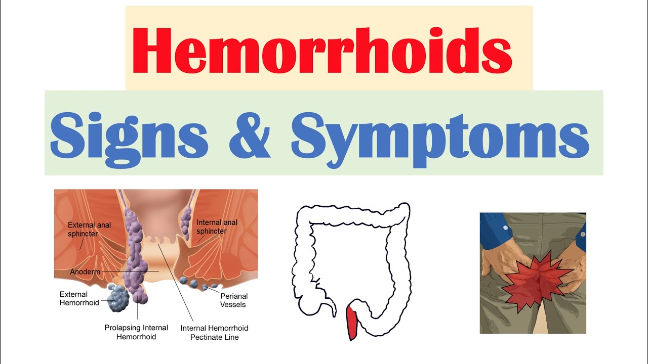 Hemorrhoids Signs & Symptoms | Internal vs. External Hemorrhoid Symptoms | Hemorrhoidal DiseaseHemorrhoidal disease involving issues with internal and extern...