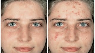 شرح كيف مسح بثور الوجه بالفوتوشوب screenshot 4