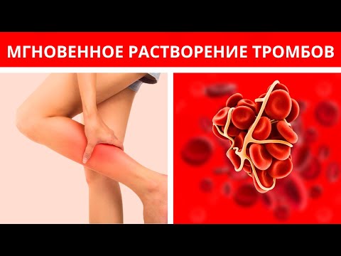 Эти 7 пищевых продуктов мгновенно приведут к растворению ТРОМБОВ в сосудах.